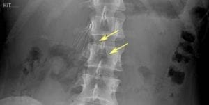 IVC FIlter Fracture - IVC filter MDL