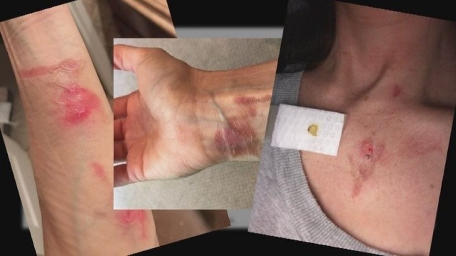 Image of Sheryl Utal's Injuries Sustained After NutriBullet Explosion