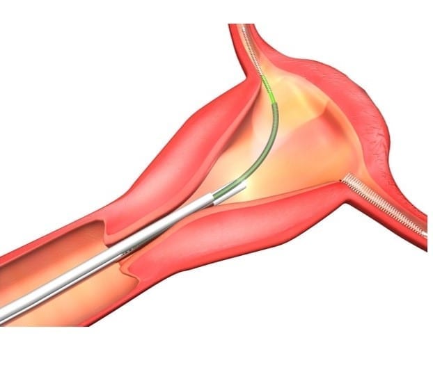 Essure being implanted; graphic by Petr Kovář MUDr. Havířov, CC BY-SA 4.0, from Wikimedia Commons, cropped.