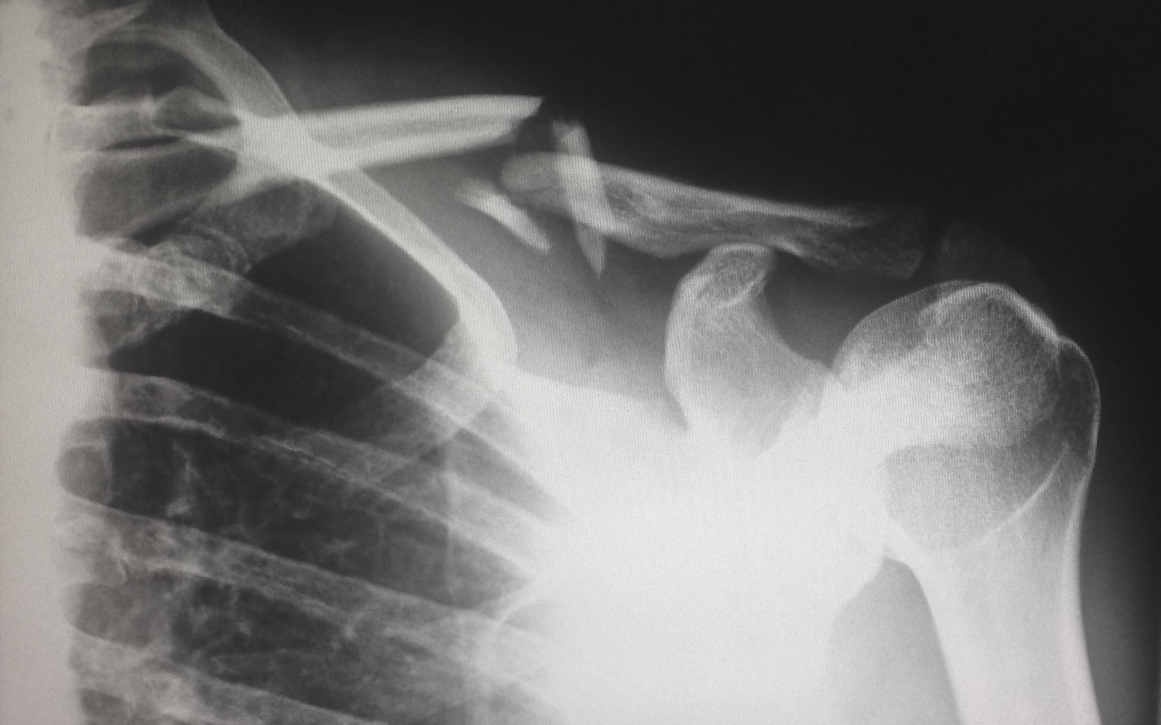 X-ray showing broken clavicle; image by Harlie Raethel, via unsplash.com.