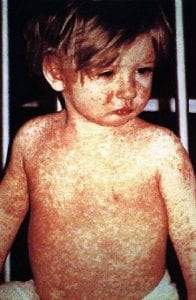 A child infected with measles