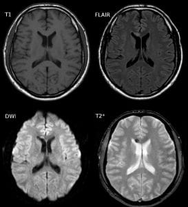 Diffuse axonal brain injury; image by Hellerhoff, via wikimedia.com, CC BY-SA 3.0, no changes.