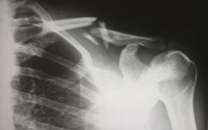 X-ray showing a broken clavicle; image by Harlie Raethel, via unsplash.com.s