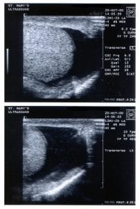 Example of testicular ultrasound; image by justgrimes, via Flickr, CC BY-SA 2.0, no changes.