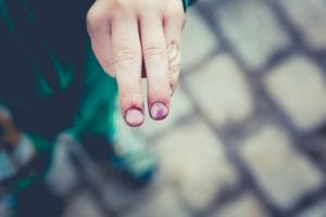 Man’s hand showing two injured fingers; image by Markus Spiske, via Unsplash.com.