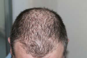 Balding man; image by kalhh, via Pixabay.com.