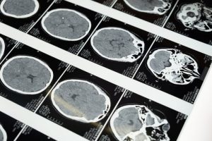 Texas A&M Team Reports Results of Traumatic Memory Reversal Study