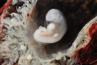 A light colored tiny blob of flesh floats inside a Fallopian tube.