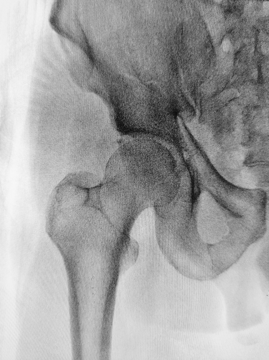 X-ray of hip fracture; image by Mehmet Turgut Kirkgoz, via Unsplash.com.
