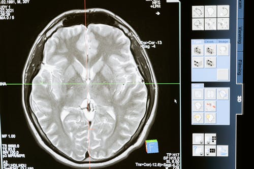 Brain Scans Shed Light on Hoarding Disorder