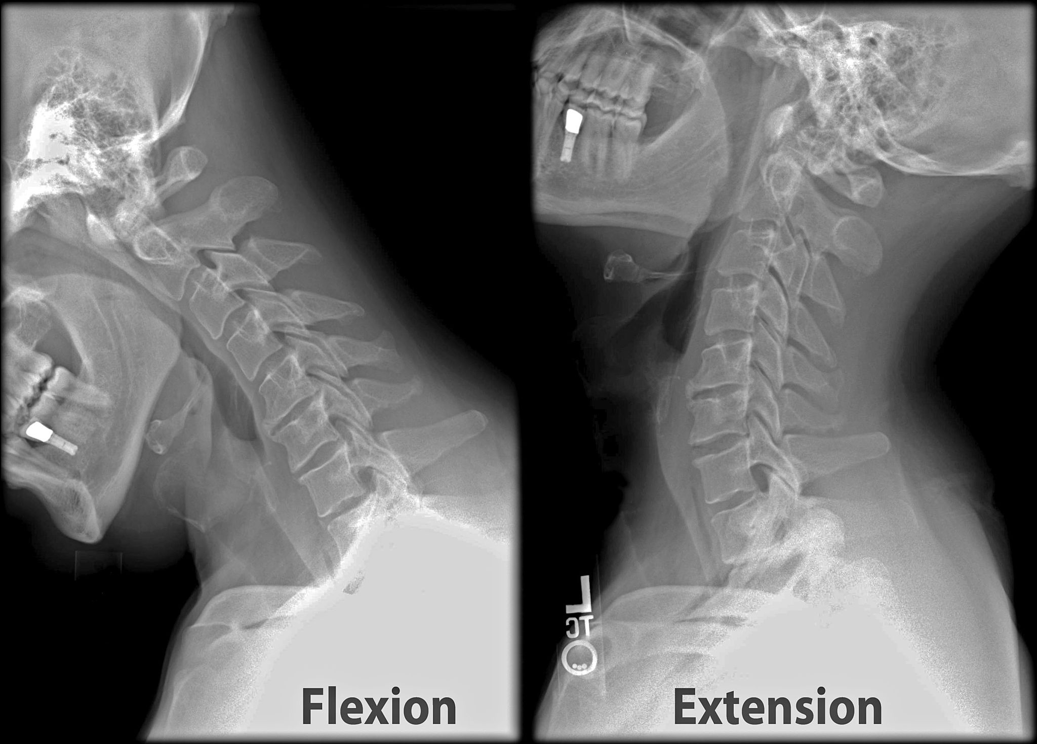 Cervical x-ray of flexion and extension; image by Stillwaterisingderivative work: F. Lamiot, CC BY-SA 3.0, via Wikimedia Commons.