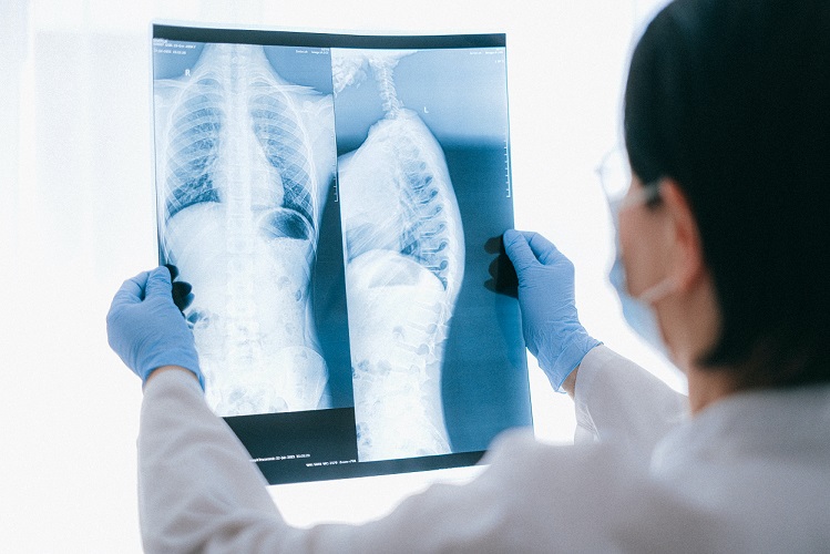 CT Chest Scanning Can Help Predict Lung Cancer Survival Rates
