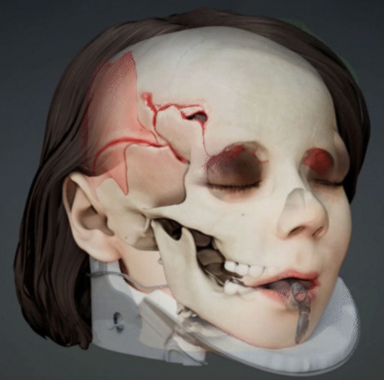 Rendering of a scan of victim's head injuries; image courtesy of Crosley Law.