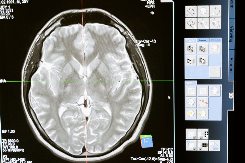 Brainoware: Integrating Human Brain Tissue with Electronics