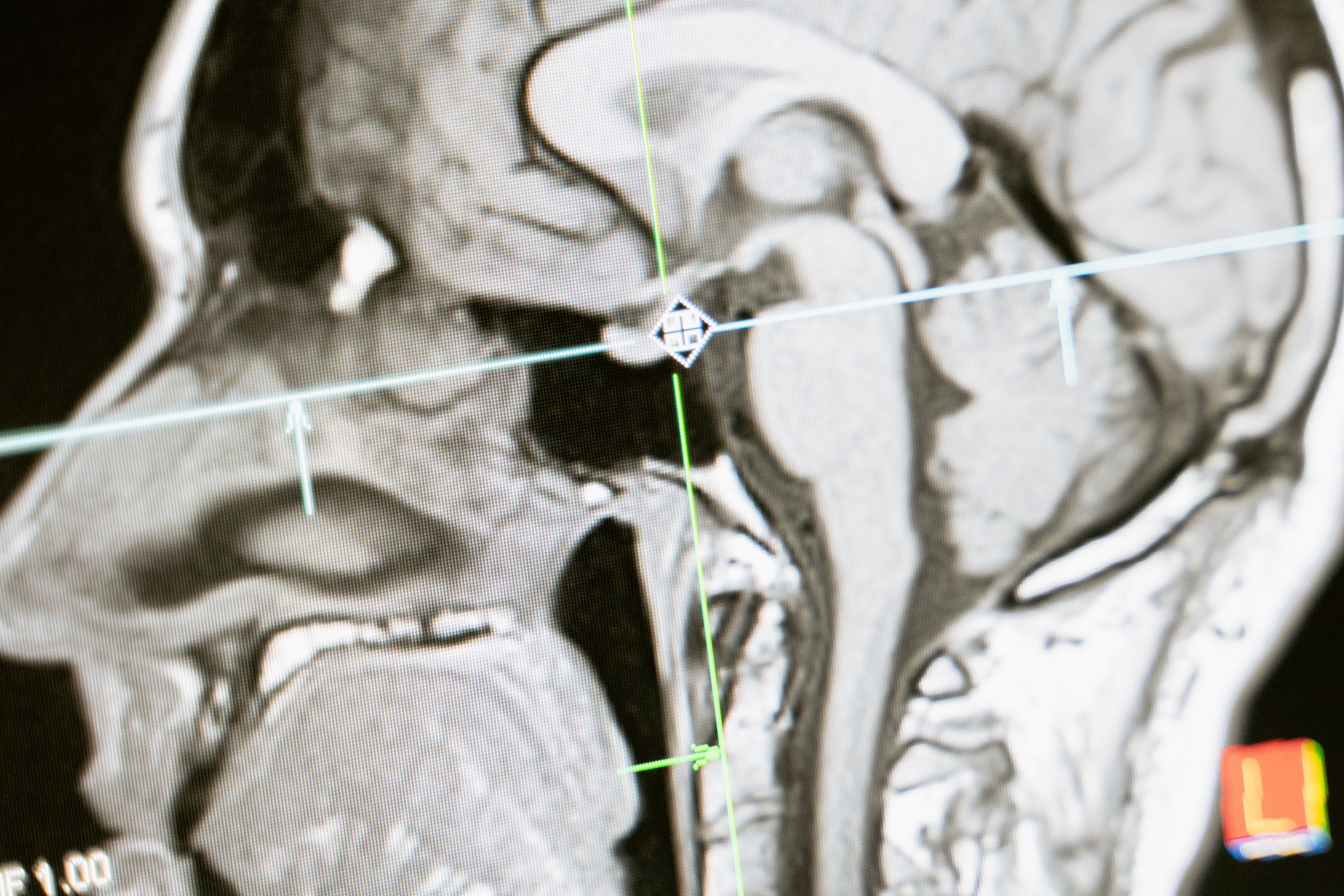 Rapamycin Reverses Autism-Like Brain Changes