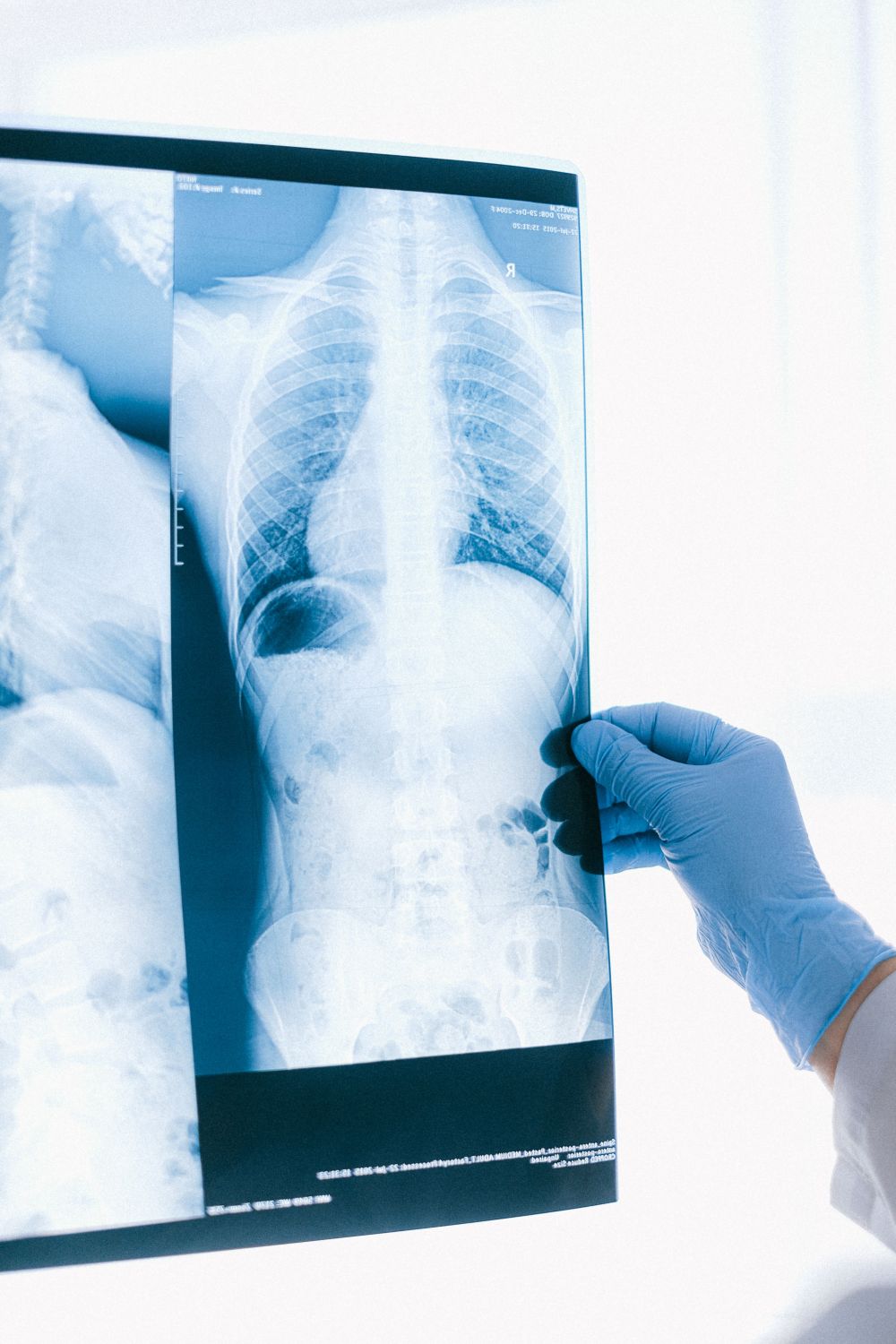 Radiosurgery Linked to Longer Lung Cancer Survival