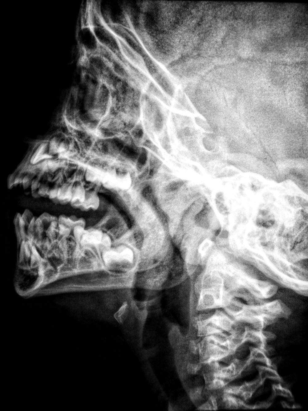 Chronic Opioid Use Common After Head, Neck Cancer Surgery
